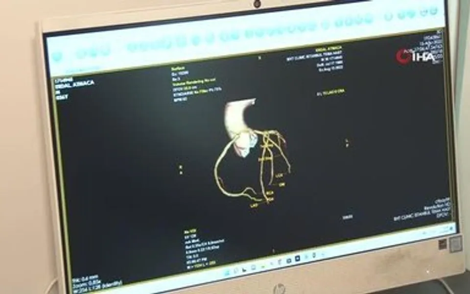 Damar tıkanıklığı hakkında program kaydından koroner damar görüntüleme karesi